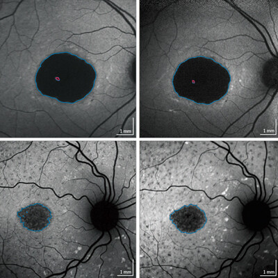 Progression of Stargardt Disease as Determined by Fundus ...