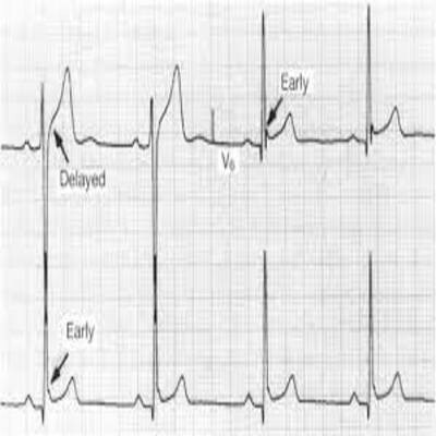 Ep 846: Early Repolarization vs. Anterior STEMI MP3 Song Download ...