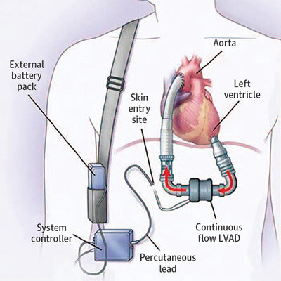 Evolution of Left Ventricular Assist Device Therapy for Advanced Heart ...